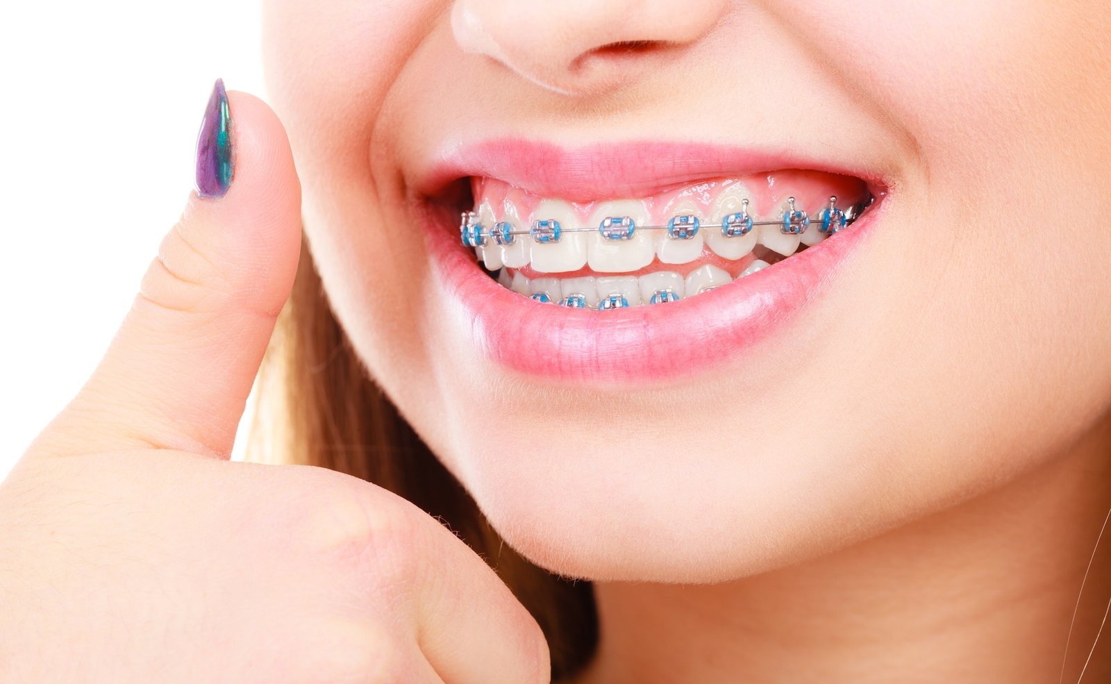 Orthodontics-London-Ontario-Rondeau-Associates